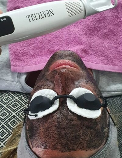 Hollywood Peel con carbon activado y laser Neatcell